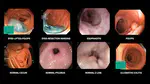 How to Train a Custom Vision Transformer (ViT) Image Classifier to Help Endoscopists in Less than 5 min